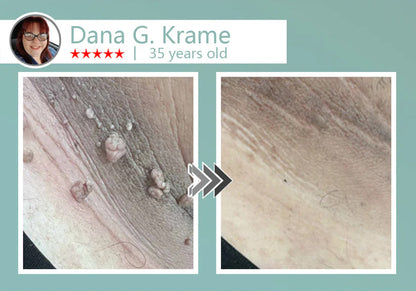 🔥Final 3 Hours: 80% OFF - LBMLBM® MicroNeedle Botanic Skin Tag Removal Patch 🇺🇸 Made in the USA