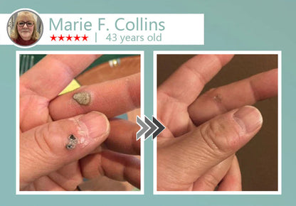 🔥Final 3 Hours: 80% OFF - LBMLBM® MicroNeedle Botanic Skin Tag Removal Patch 🇺🇸 Made in the USA