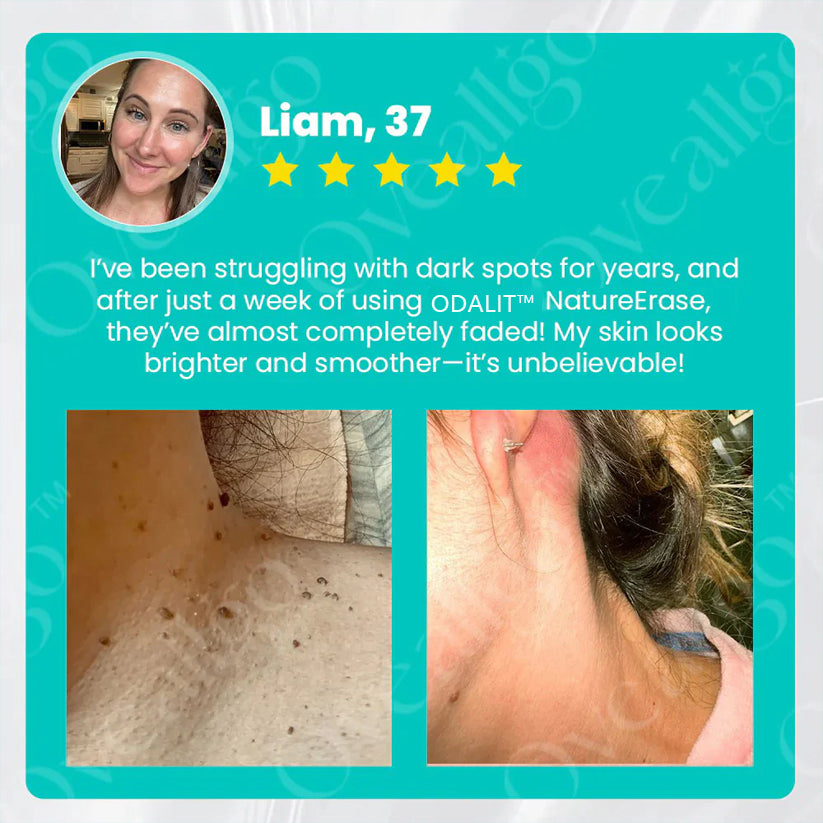 ✅ Official Store: ODALIT™ NatureErase Instant Alligator Oil Mole & Spot Removal Plus Gel