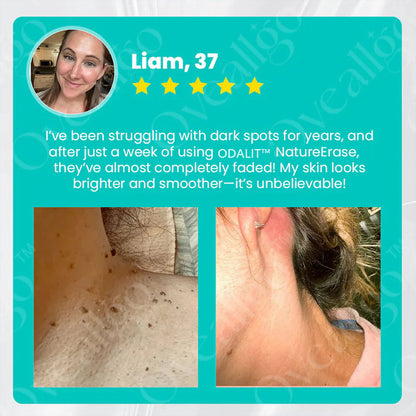 ✅ Official Store: ODALIT™ NatureErase Instant Alligator Oil Mole & Spot Removal Plus Gel