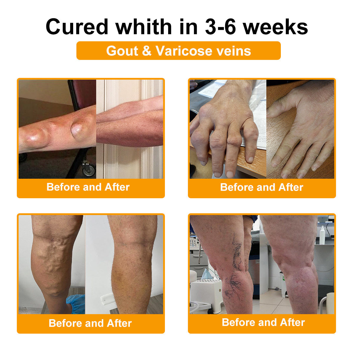 🔥Final 3 Hours: 80% OFF - ODALIT™ Botulinum Toxin & Bee Venom Pain-Relief Bone Healing Cream🐝