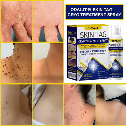 🔥Final 3 Hours: 80% OFF - ODALIT® Skin Tag Cryo Treatment Spray