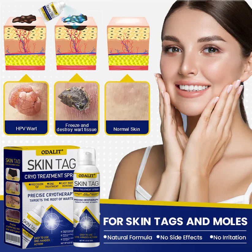 🔥Final 3 Hours: 80% OFF - ODALIT® Skin Tag Cryo Treatment Spray