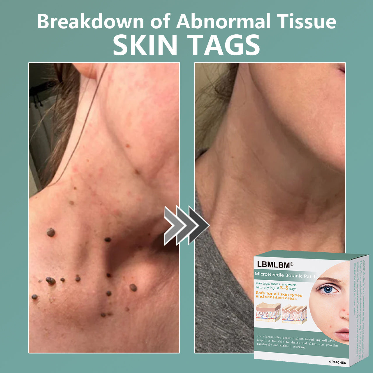🔥Final 3 Hours: 80% OFF - LBMLBM® MicroNeedle Botanic Skin Tag Removal Patch 🇺🇸 Made in the USA