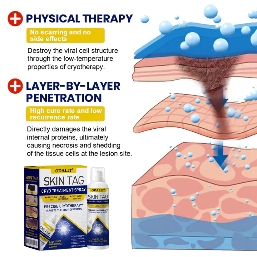🔥Final 3 Hours: 80% OFF - ODALIT® Skin Tag Cryo Treatment Spray